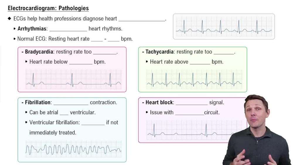 Electrocardiogram: Pathologies
