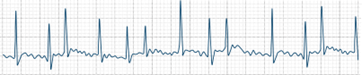 ECG strip showing irregular, rapid heartbeats indicative of ventricular fibrillation with chaotic waveforms.