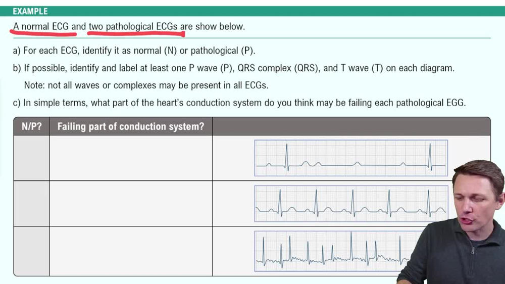 Electrocardiogram (ECG) Example 2