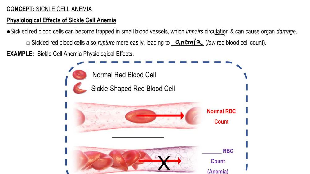 Sickle Cell Anemia