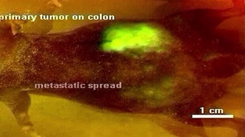 Short Video: Tumor Growth