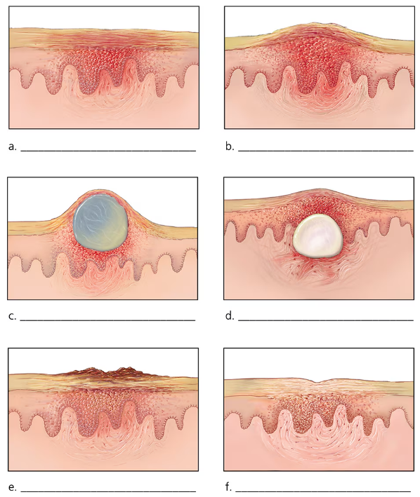 Series of six detailed skin cross-sections showing progressive stages of smallpox lesions from initial redness to scab formation and healing.
