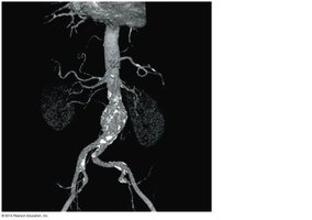 CT angiogram of an abdominal aortic aneurysm